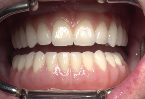 Learning objectives The purpose of the course is to share with participants deep theoretical knowledge and practical experience in treatment of fully edentulous patients using Straumann Pro Arch