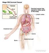 Cervical Cancer: Stage IV Stage IV: Tumor extends beyond the true pelvis or has involved bladder or rectal mucosa Chemotherapy + Radiation therapy IVA: Spread to adjacent organs IVB: Spread to
