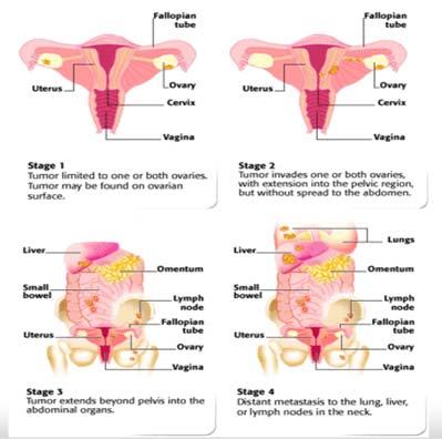 Ovarian Cancer Stage I: Organ Stage II: Local Stage III: Regional Stage IV: Distant Stage I: Tumor confined to ovary IA: Limited to one ovary, negative ascites, no tumor on surface, capsule intact