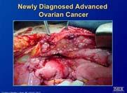 Ovarian Cancer Therapy Surgery + Chemotherapy REMISSION Recurrence Therapy Maintenance