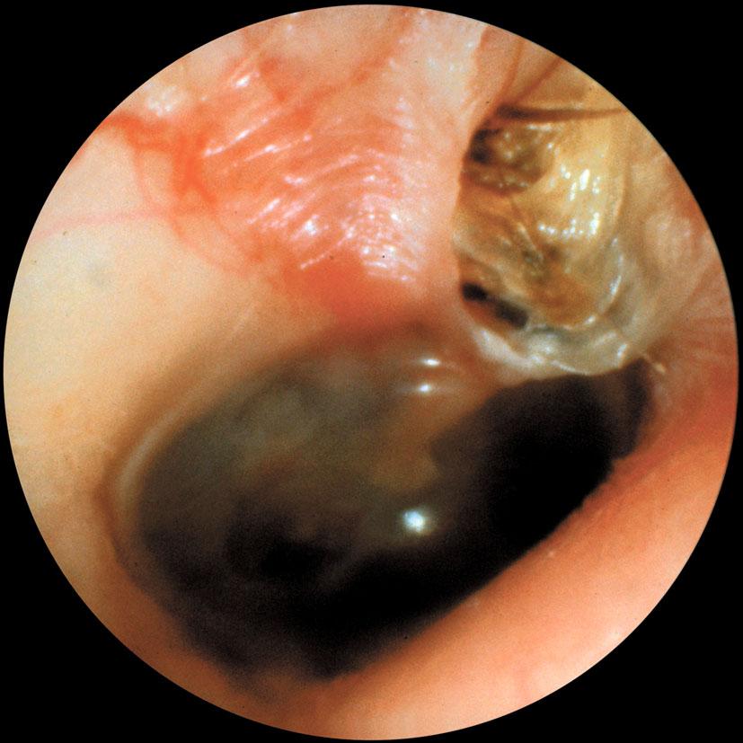 63 Page 2 of 7 Curr Surg Rep (2014) 2:63 Fig. 1 Retraction pocket cholesteatoma of the pars flaccida portion of the tympanic membrane in a left ear.