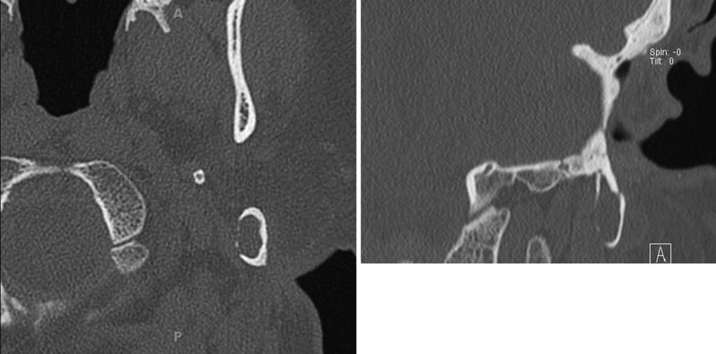 Curr Surg Rep (2014) 2:63 Page 3 of 7 63 Table 1 MRI characteristics of cholesteatoma versus granulation tissue Sequence Cholesteatoma Granulation tissue T1 Intermediate signal Intermediate signal T2