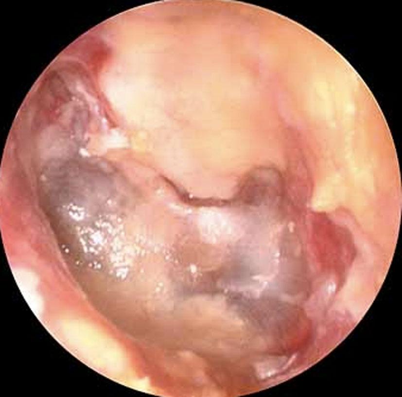 (Fig. 3). The 1 cm area of soft tissue density in the left mastoid tip demonstrated diffusion restriction consistent with recurrent cholesteatoma.