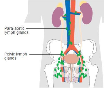 Pelvic + Para-aortic Lymphadenectomy Prevalance of metastases to LN s in HR