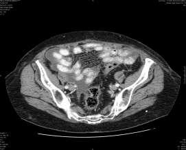 Liver metastases: correlated with Primary (no more than 3 for CRC) Clear Zone II Small bowel
