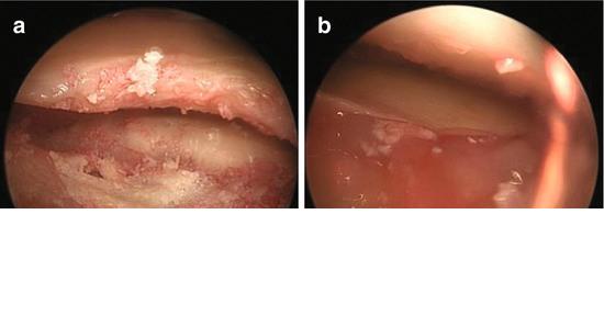 An arthroscopic image of an isolated tibial plateau lesion after being filled with the BioCartilage/PRP mixture (a) and after sealing the defect with fibrin glue (b) Postoperative Care The patient
