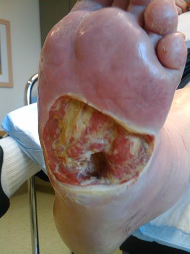 Grade 3 Deep ulcer with cellulitis or