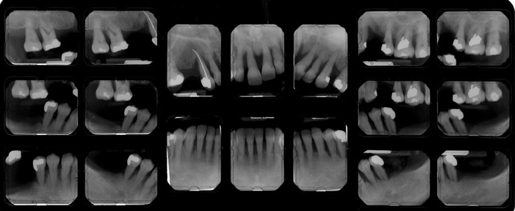 The new prosthesis consisted of a robotically milled titanium frame and an AvaDent resinveneer dentition. Case Report In 1984, a 55-year-old patient presented with a chief complaint of poor esthetics.