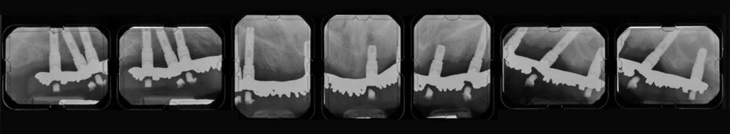 829 Left Right Fig 2 Maxillary teeth were removed, and the final maxillary prosthesis (supported by six implants) was loaded in 1986.