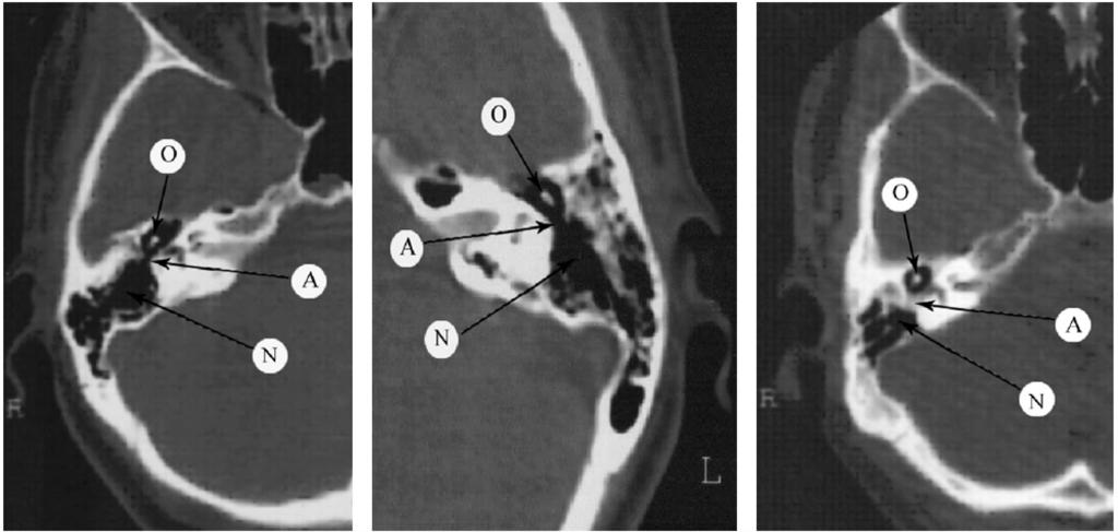 Ahmad S. El-Kady, et al. 55 Table (1): CT findings of the studied cases. Number Closed aditus Number Aditus Open aditus % Number % Table (2): Correlation between CT results and surgical results.