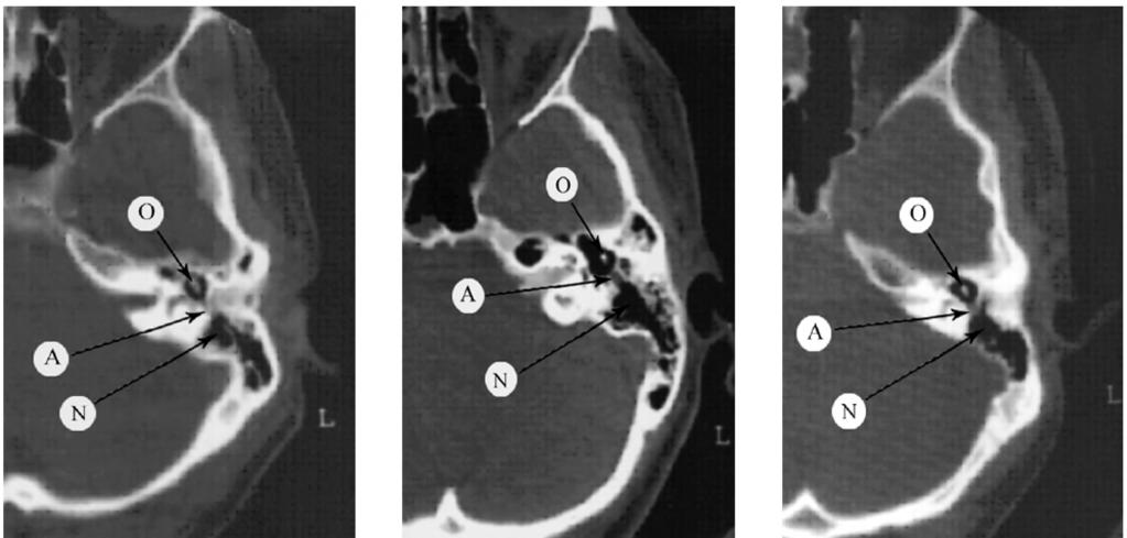 (1): Axial CT scan showing opened right aditus ad antrum [(A) Aditus, Fig. (2): Axial CT scan showing opened left aditus ad antrum [(A) Aditus, Fig.