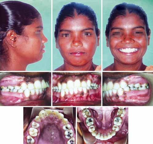 JIOS Orthodontic-Surgical Management of a Skeletal Class II Patient with Reverse Smile Arc and Vertical Maxillary Excess to setback the anterior alveolar segment by 6 mm.