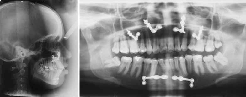 Surgeries were performed without any complications and the correction was maintained by rigid fixation. This was followed by postsurgical orthodontics during which second molars were bonded.