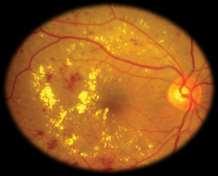 (DME), a major cause of visual impairment in diabetic