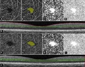 Macular ischemia Severe ischemia To quantify foveal avascular zone (FAZ) area and macular vascular density objectively and to examine correlations with visual acuity Decreasing