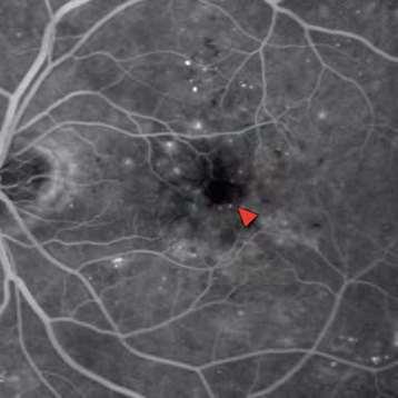 Fluorescein Angiography FA is the gold standard in retinal imaging due to the capacity to visualize the retinal
