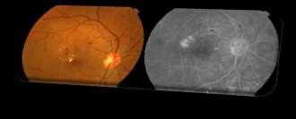 Ischaemic maculopathy Optical