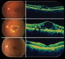 Optical coherence tomography (OCT) Macular thickness may be automatically and reproducibly quantified which is