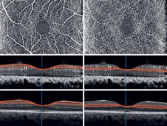 Optical Coherence Tomography Angiography (OCT-A) A new method of non-invasive examination, which allows the visualization of the entire retinal and choroidal vasculature in a depth-resolved manner.