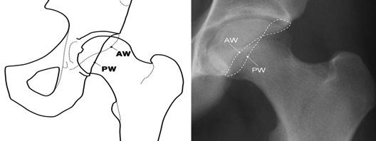 Crossover Sign This is defined with the anterior rim