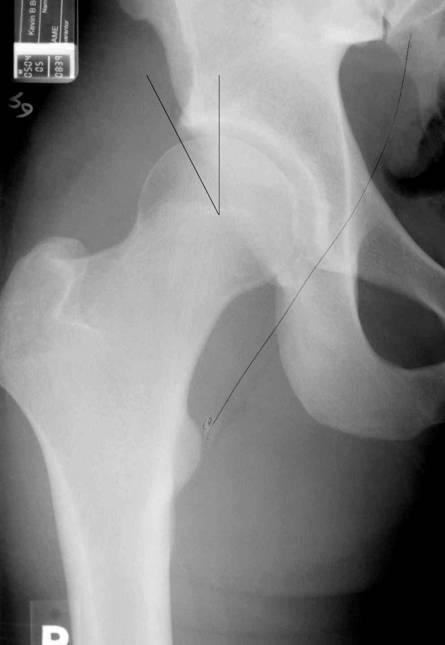 Acetabular Dysplasia Acetabular Dysplasia is characterized by a shallow and relatively vertical acetabulum, and may predispose to hip