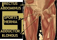 Sports Hernia/ Athletic Pubalgia Pathology: Thought to result from simulataneous trunk hyperextension and
