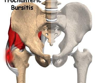 ITB/Greater Trochanteric Bursitis Pathology: thickened IT Band or glute maximus over
