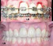 20 Chapter 22 Orthodontic treatment combined with Oral Surgery Description of the most common orthognathic surgeries used today. 1. The Lefort I down-fracture p 589 2.