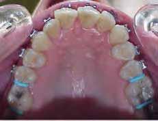 from the occlusal