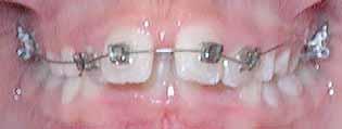 Never place bite-opening wires on flared incisors or they will only flare outward even more, with no intrusion.