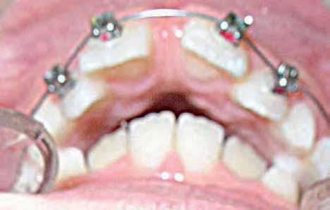 Space is gained for 33 & 43 by the advancement of the incisors: Md1 to A-pog line = -2 mm and Md1 to NB = 3 mm &