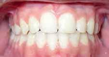 careful because if the lower incisors are ligatured to the wire, they will rapidly
