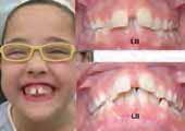 Case: Ki, girl, dental age 10. Full CLII div I dental and skeletal.