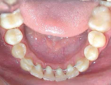 Wire should be on gingival 1/3 of