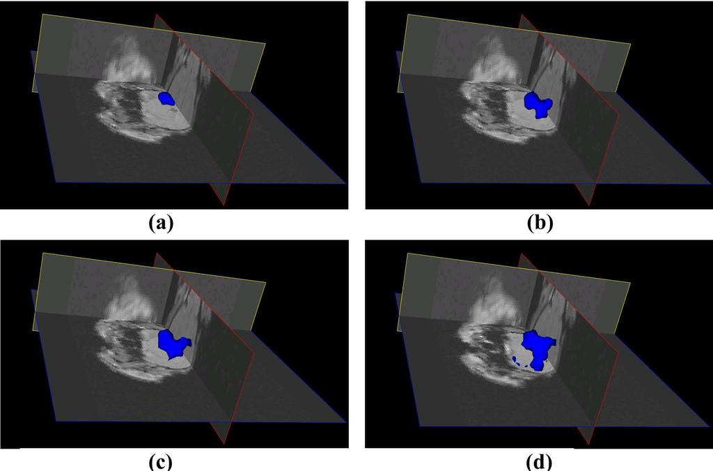 334 Forkert et al. Fig. 3. Selected frames of the dynamic visualization of acute stroke growth for the timepoints t = 0min (a), t = 18min (b), t = 36min (c) and t = 50min (d).