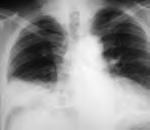 D D Transmittable disease Mode of Transmission Symptoms Complications Pneumococcus Air, direct contact.