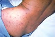 D D Transmittable disease Mode of Transmission Symptoms Complications Varicella (chickenpox) Air, direct contact.