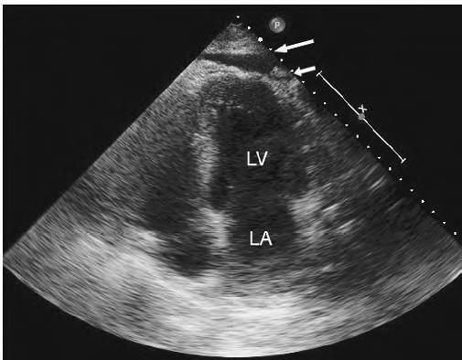Differentiation of Pericardial from Pleural Effusion