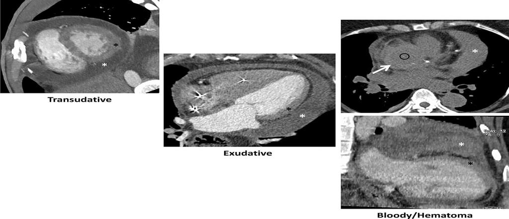 Pericardial effusion on CT Localization and quantitation of pericardial fluid