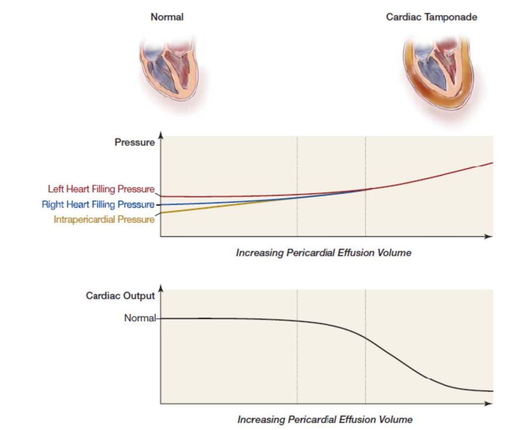 Pathophysiology of cardiac tamponade Intrapericardial Pressure equal