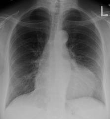 Diagnosis of cardiac tamponade Chest PA ECG Enlarged cardiac silhouette (>250ml)