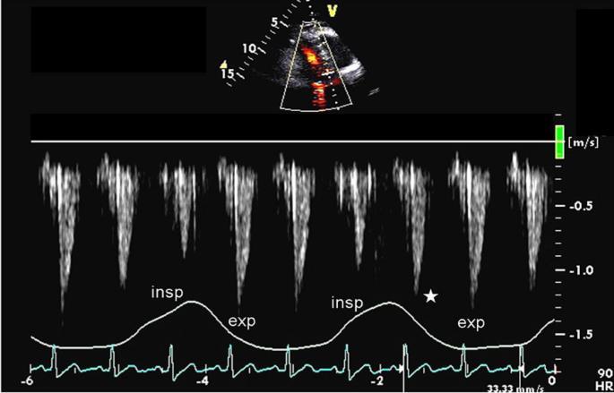 Echocardiographic findings in