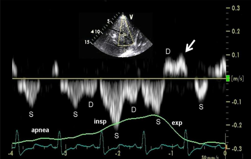 Echocardiographic findings in cardiac tamponade -Diastolic