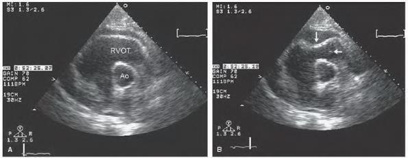 Echocardiographic findings in cardiac tamponade RV, RA collapse at early diastolic phase (AV, PV closing)