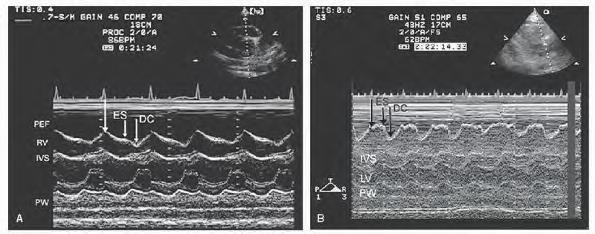 Echocardiographic findings in cardiac tamponade RV, RA collapse