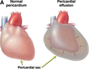 Pericardial effusion Abnormal