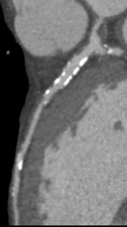 in LAD and LCX calcified plaques