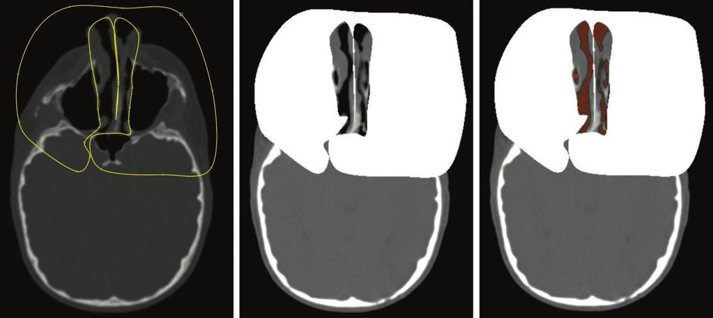 Plastic and Reconstructive Surgery August 2010 Fig. 1. Example of the step-by-step exclusion of paranasal sinuses. By manually creating a contour in each slice (left), a mask can be computed(center).