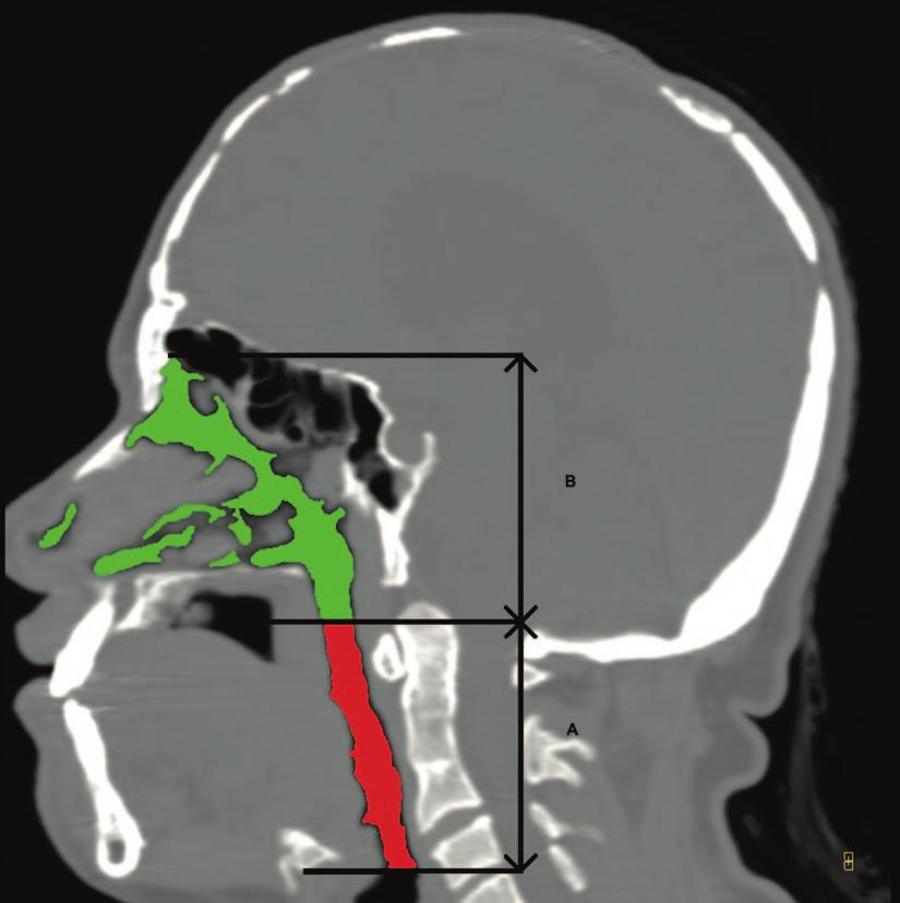 for areas of interest. Exclusion of the oral cavity took place in a similar way. Fig. 2. Computed tomographic scan in midsagittal view. The three lines mark the boundaries of compartments A and B.