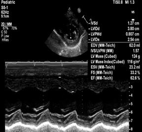 beats per minutes and no documented ventricular or supraventricular ectopy. Echocardiography showed: large coronary fistula seen in MPA.